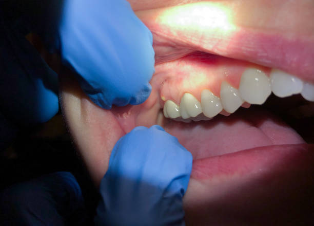 Best Broken Tooth Emergency  in Baidland, PA